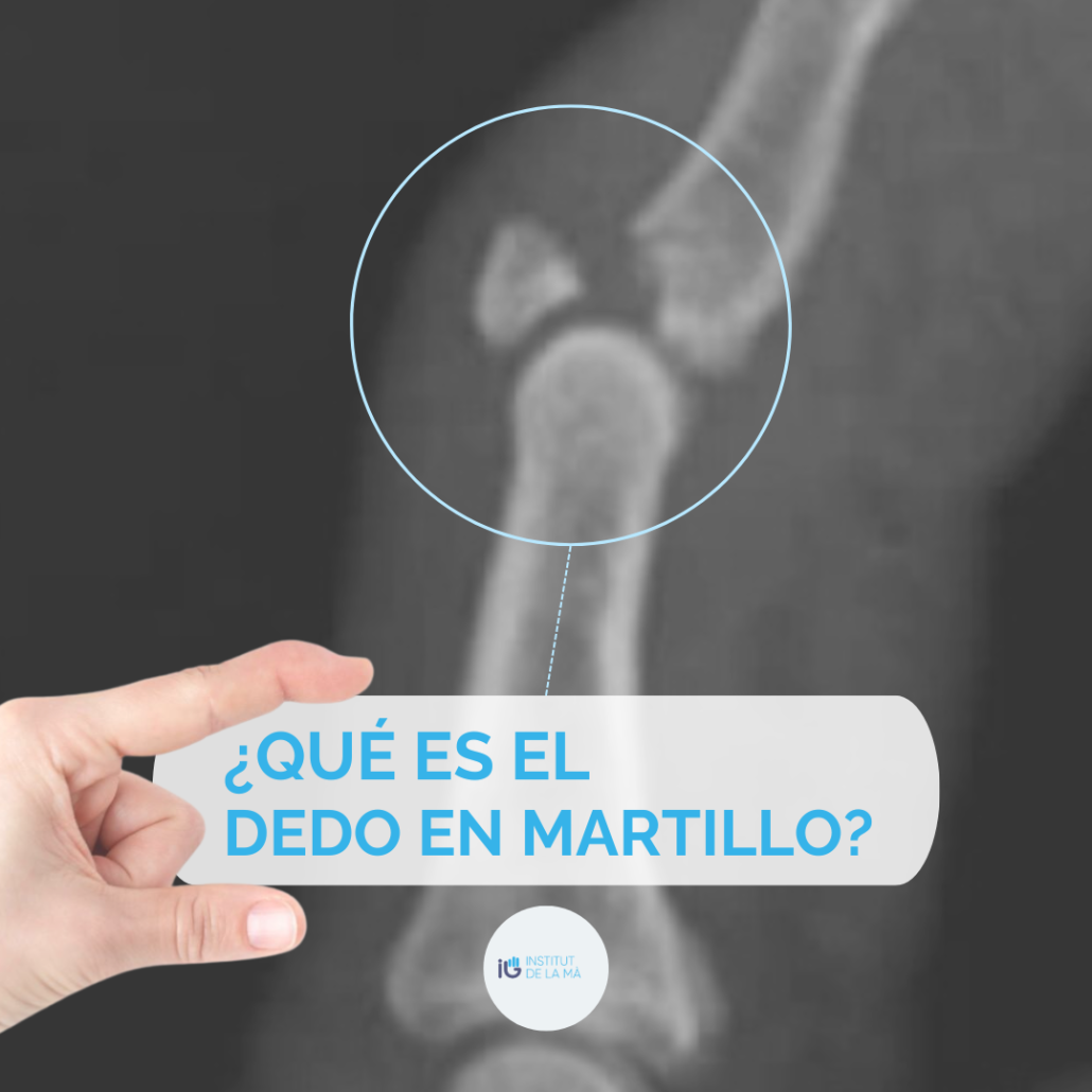 Dedo En Martillo Diagn Stico Y Tratamiento Institutdelama Es