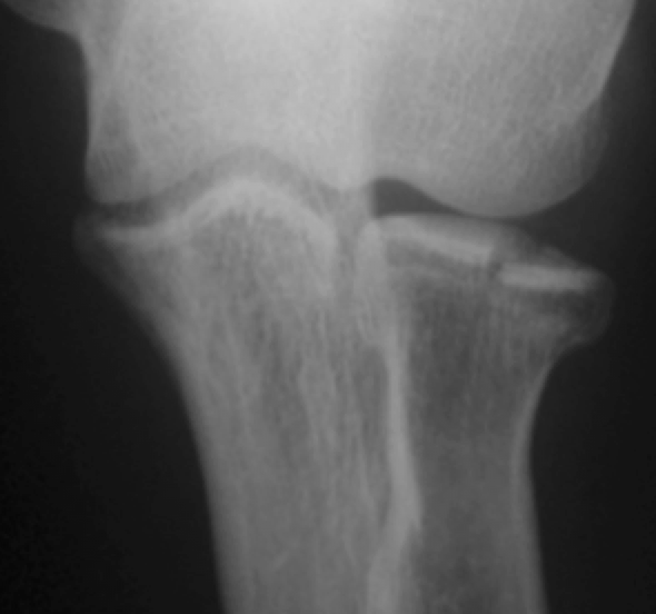 CASO FRACTURA DE CÚPULA o CABEZA RADIAL MASSON III icatMA