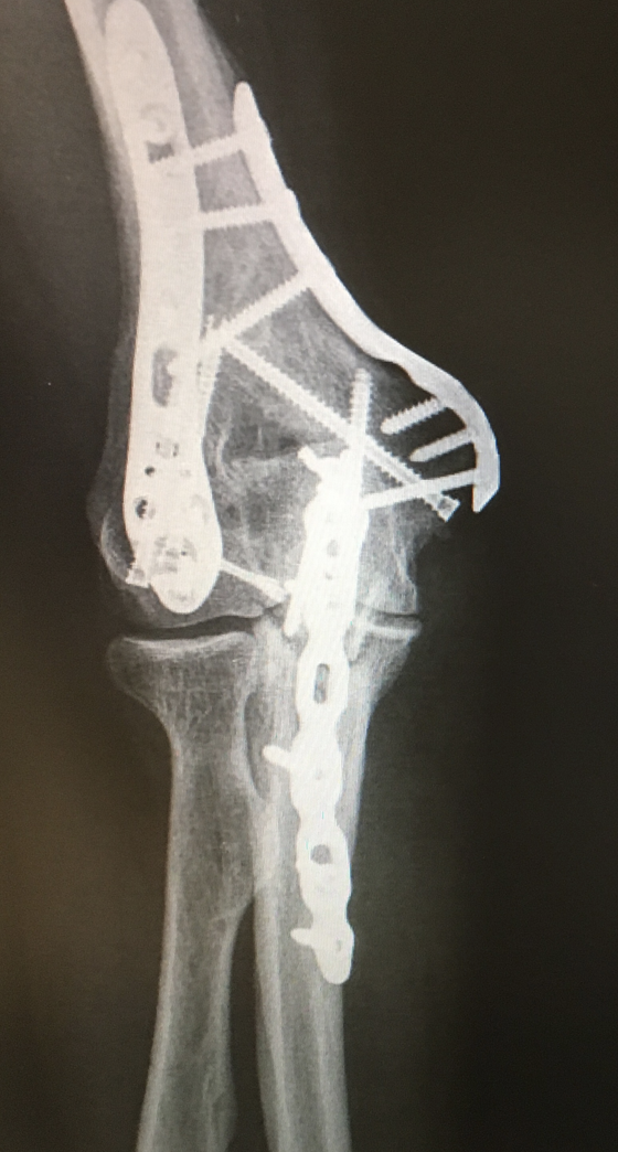 FRACTURA DE HÚMERO DISTAL icatMA