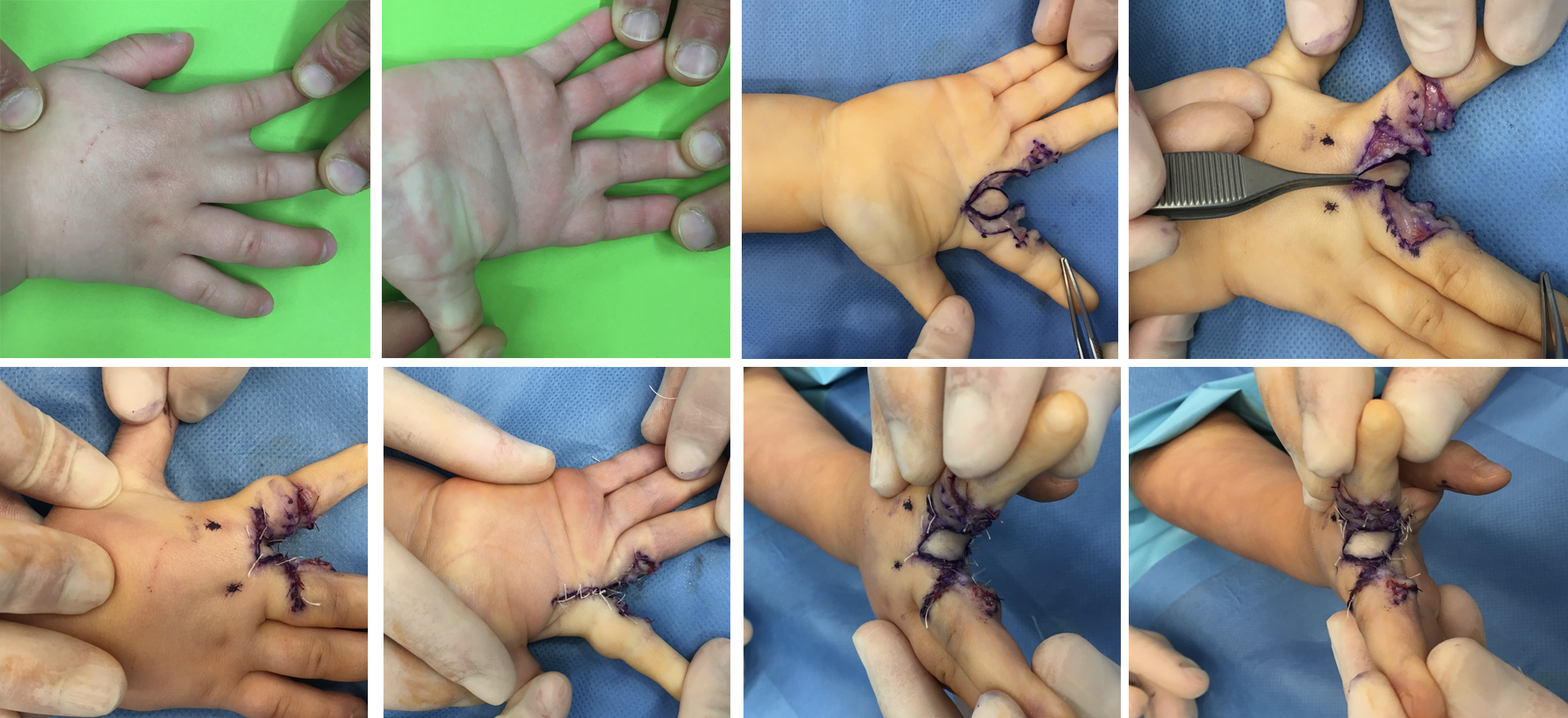Sindactilia mano, malformación frecuente en niños