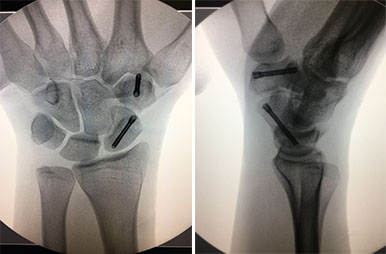 fractura escafoides icatMA