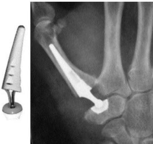 prótesis rizartrosis icatMA