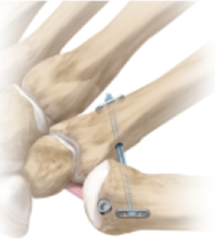 tratamiento rizartrosis pulgar icatMA