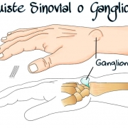 Quiste sinovial o ganglión