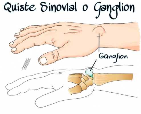 Quiste sinovial o ganglión