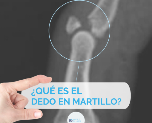 Qué es el dedo en martillo por Institut de la Mà